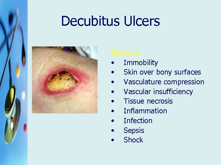 Decubitus Ulcers Bed sore • Immobility • Skin over bony surfaces • Vasculature compression