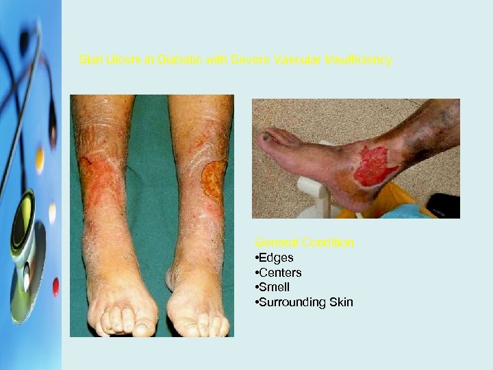 Skin Ulcers in Diabetic with Severe Vascular Insufficiency General Condition • Edges • Centers