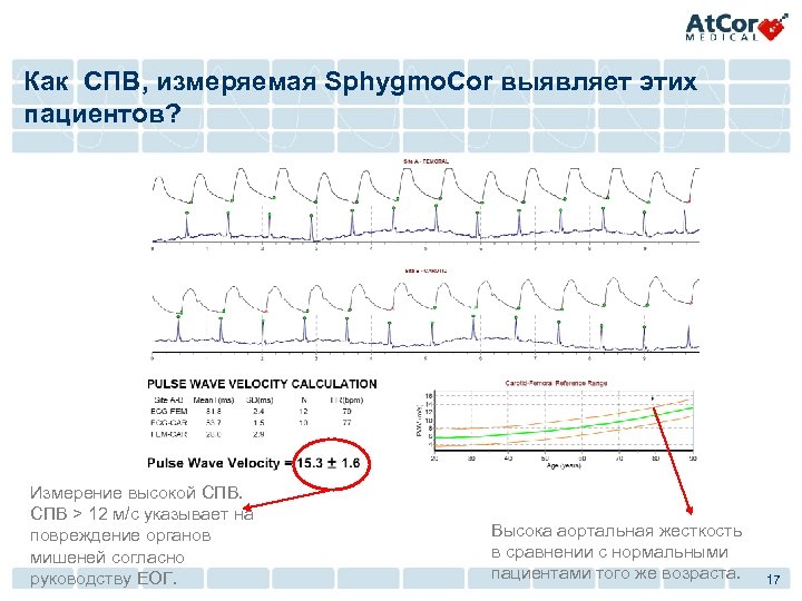 Как СПВ, измеряемая Sphygmo. Cor выявляет этих пациентов? Измерение высокой СПВ > 12 м/с