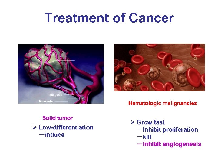 Treatment of Cancer Hematologic malignancies Solid tumor Ø Low-differentiation －induce Ø Grow fast －Inhibit