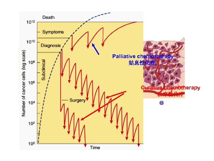 Palliative chemotherapy 姑息性化疗 Curative chemotherapy 治疗性化疗 