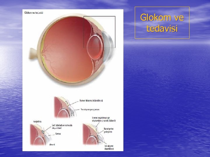 Glokom ve tedavisi 