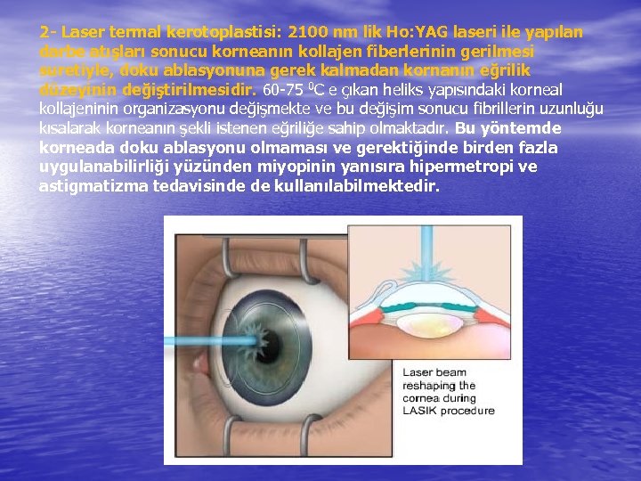 2 - Laser termal kerotoplastisi: 2100 nm lik Ho: YAG laseri ile yapılan darbe