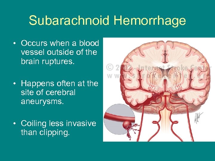 Subarachnoid Hemorrhage • Occurs when a blood vessel outside of the brain ruptures. •