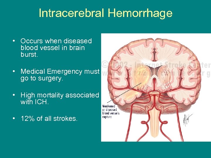 Intracerebral Hemorrhage • Occurs when diseased blood vessel in brain burst. • Medical Emergency