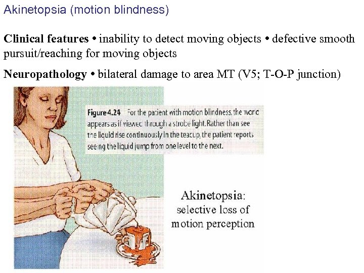 Akinetopsia (motion blindness) Clinical features • inability to detect moving objects • defective smooth