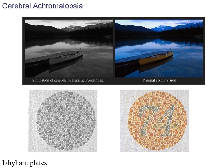 Cerebral Achromatopsia Ishyhara plates 