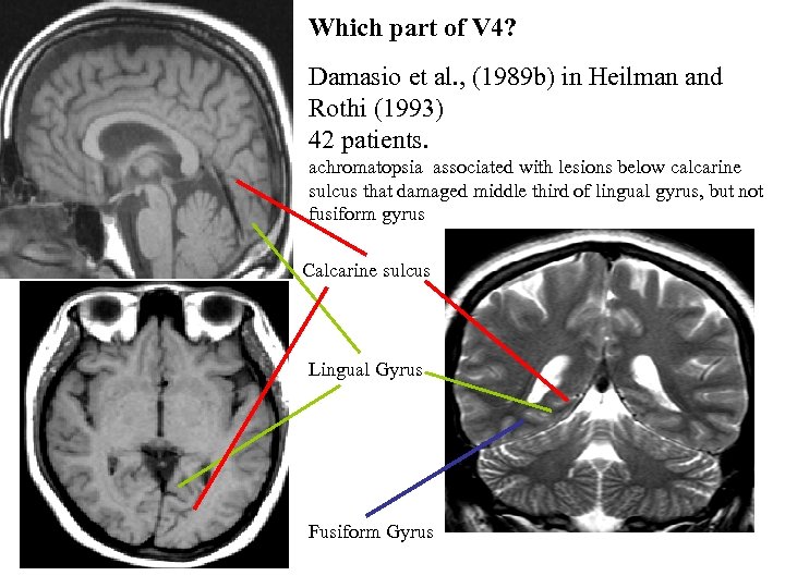 Which part of V 4? Damasio et al. , (1989 b) in Heilman and