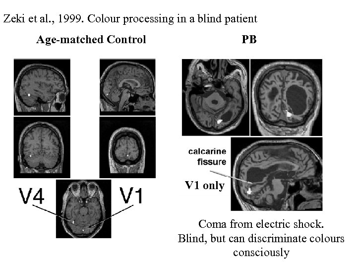 Zeki et al. , 1999. Colour processing in a blind patient Age-matched Control PB