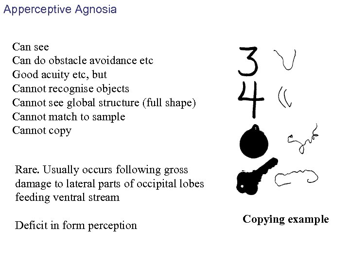 Apperceptive Agnosia Can see Can do obstacle avoidance etc Good acuity etc, but Cannot