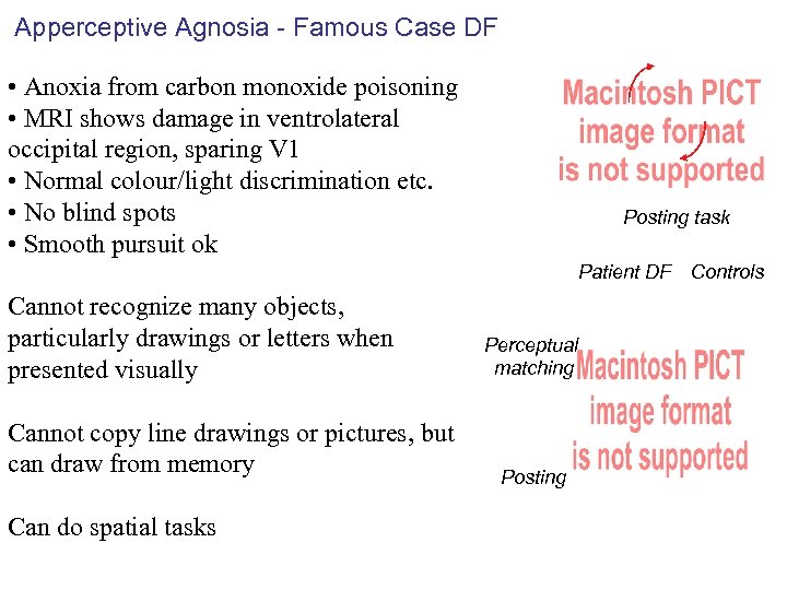 Apperceptive Agnosia - Famous Case DF • Anoxia from carbon monoxide poisoning • MRI