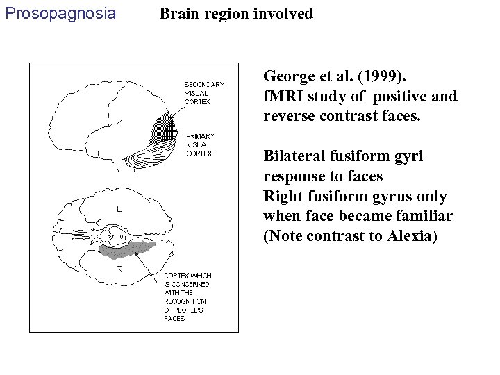 Prosopagnosia Brain region involved George et al. (1999). f. MRI study of positive and