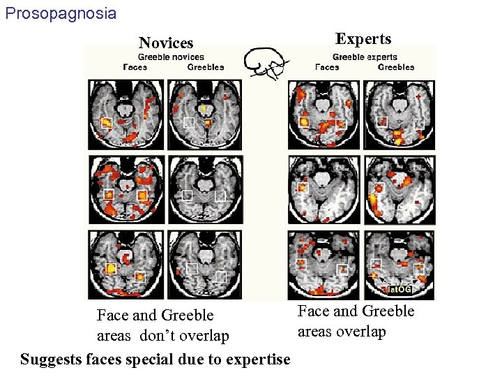 Prosopagnosia Novices Experts Face and Greeble areas overlap areas don’t overlap Suggests faces special