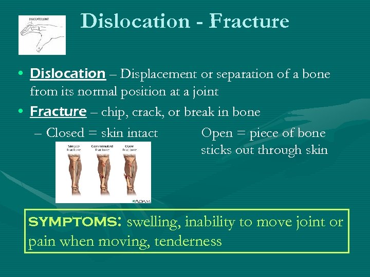 Dislocation - Fracture • Dislocation – Displacement or separation of a bone from its