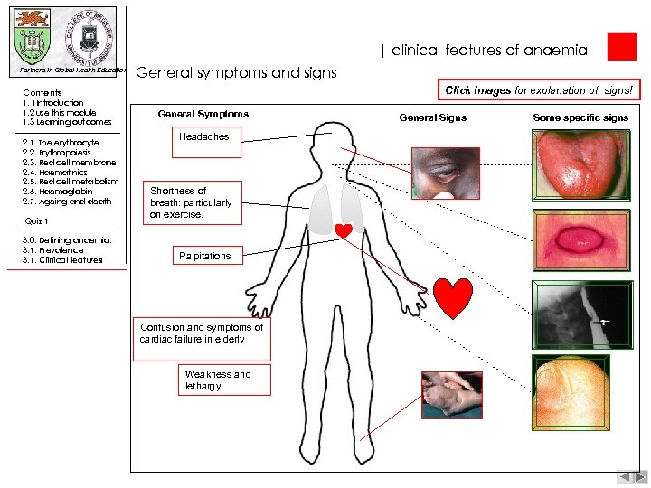 | clinical features of anaemia Partners in Global Health Education General symptoms and signs