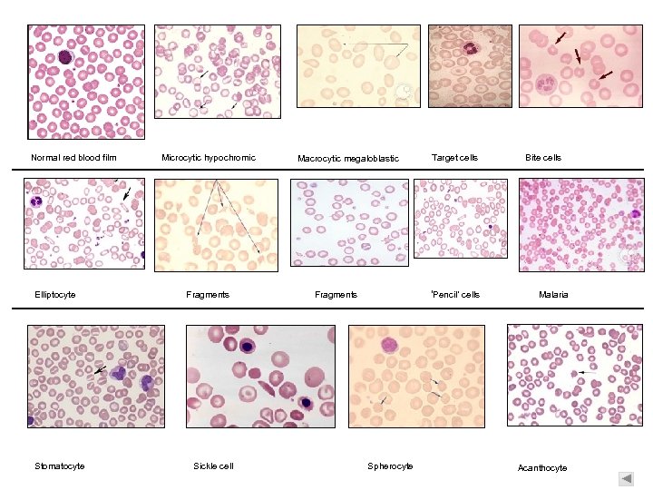 Normal red blood film Elliptocyte Stomatocyte Microcytic hypochromic Fragments Sickle cell Macrocytic megaloblastic Fragments