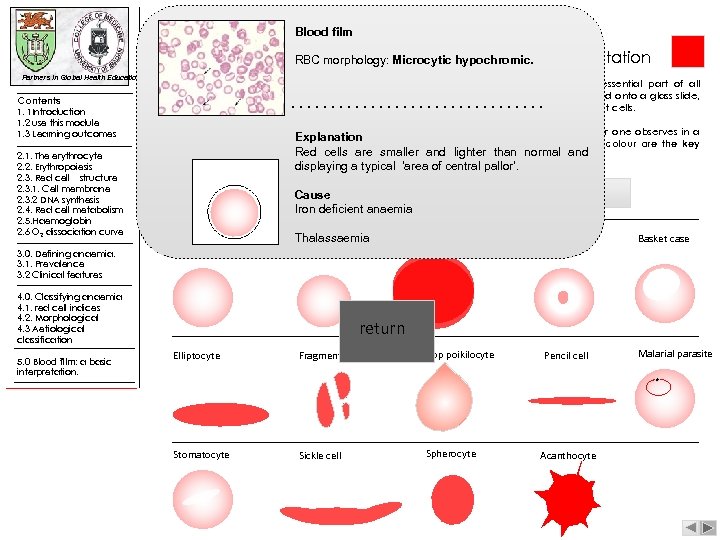 Blood film RBC morphology: |blood film: a basic Microcytic hypochromic. Partners in Global Health