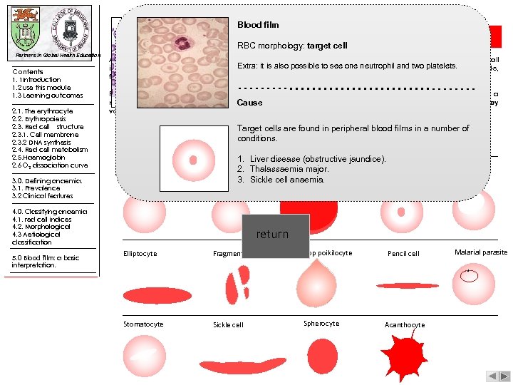 Blood film |blood film: a RBC morphology: target cell Partners in Global Health Education