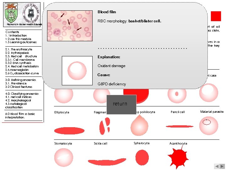 Blood film |blood film: a basic interpretation RBC morphology: basket/blister cell. Partners in Global