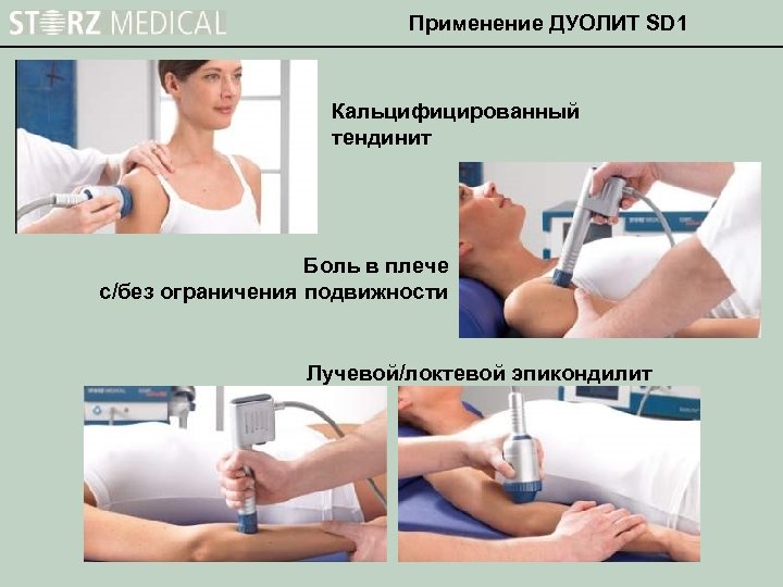 Применение ДУОЛИТ SD 1 Кальцифицированный тендинит Боль в плече с/без ограничения подвижности Лучевой/локтевой эпикондилит