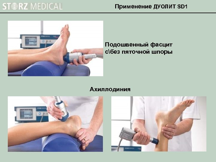 Применение ДУОЛИТ SD 1 Подошвенный фасцит сбез пяточной шпоры Ахиллодиния 