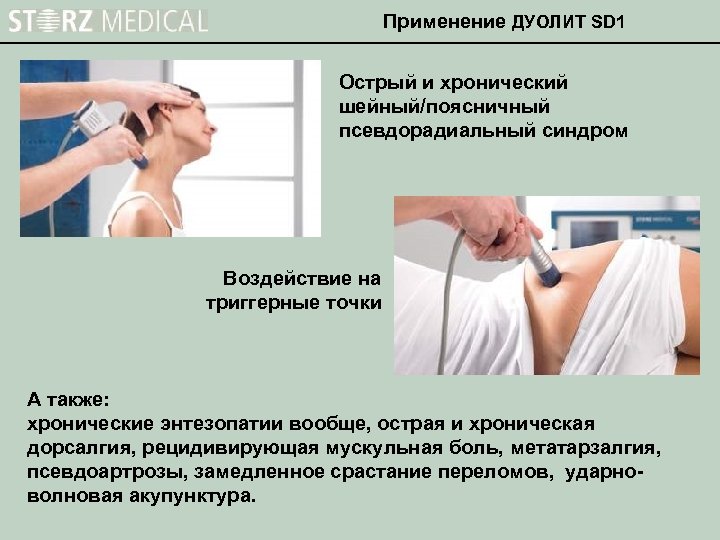 Применение ДУОЛИТ SD 1 Острый и хронический шейный/поясничный псевдорадиальный синдром Воздействие на триггерные точки