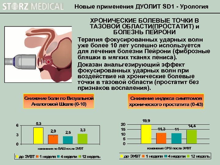 Новые применения ДУОЛИТ SD 1 - Урология ХРОНИЧЕСКИЕ БОЛЕВЫЕ ТОЧКИ В ТАЗОВОЙ ОБЛАСТИ(ПРОСТАТИТ) и