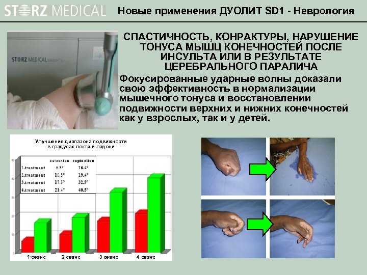 Новые применения ДУОЛИТ SD 1 - Неврология СПАСТИЧНОСТЬ, КОНРАКТУРЫ, НАРУШЕНИЕ ТОНУСА МЫШЦ КОНЕЧНОСТЕЙ ПОСЛЕ
