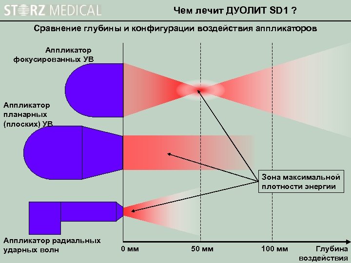 Чем лечит ДУОЛИТ SD 1 ? Сравнение глубины и конфигурации воздействия аппликаторов Аппликатор фокусированных