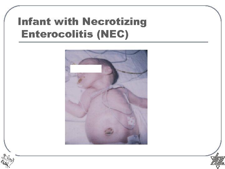 Infant with Necrotizing Enterocolitis (NEC) 