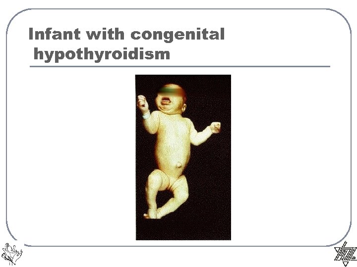Infant with congenital hypothyroidism 
