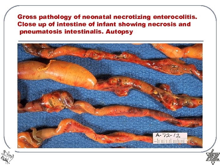 Gross pathology of neonatal necrotizing enterocolitis. Close up of intestine of infant showing necrosis