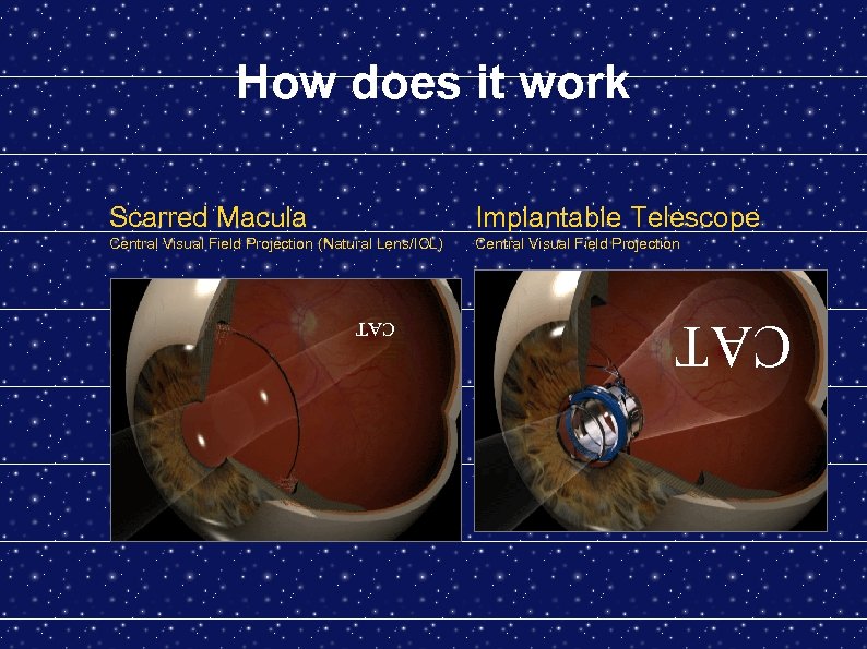 How does it work Scarred Macula Implantable Telescope Central Visual Field Projection (Natural Lens/IOL)