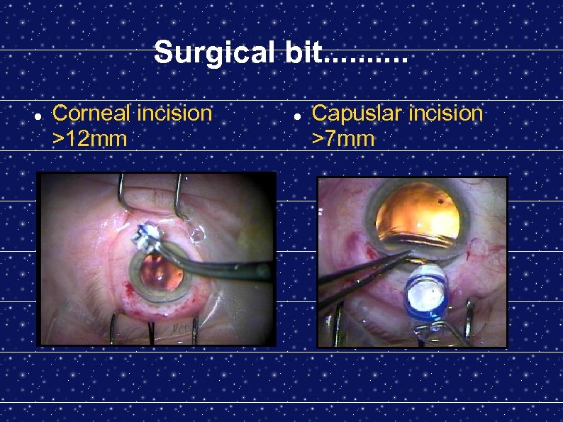 Surgical bit. . Corneal incision >12 mm Capuslar incision >7 mm 