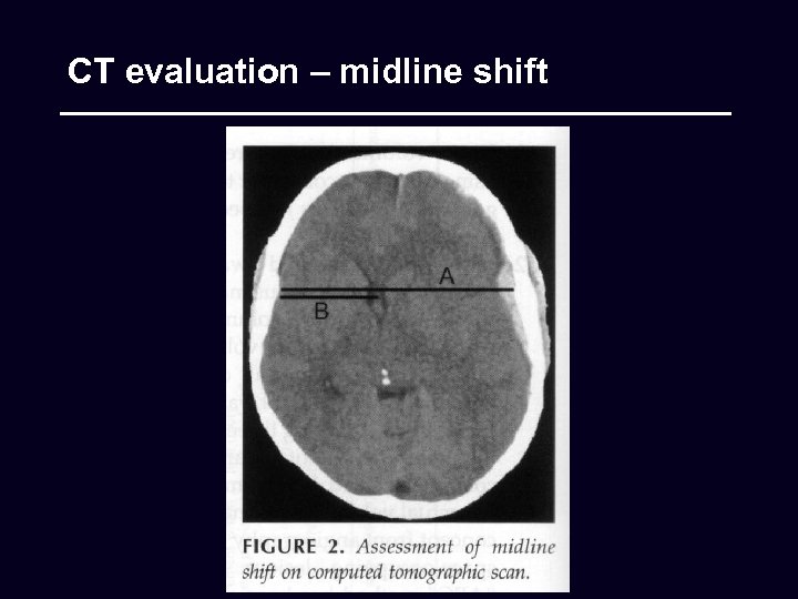 CT evaluation – midline shift 