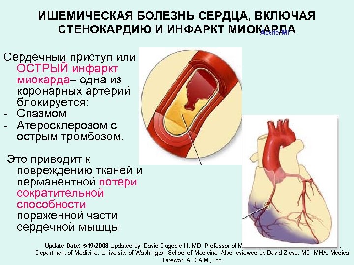 ИШЕМИЧЕСКАЯ БОЛЕЗНЬ СЕРДЦА, ВКЛЮЧАЯ СТЕНОКАРДИЮ И ИНФАРКТ МИОКАРДА Acute MI Сердечный приступ или ОСТРЫЙ