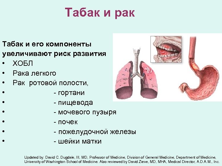 Табак и рак Табак и его компоненты увеличивают риск развития • ХОБЛ • Рака
