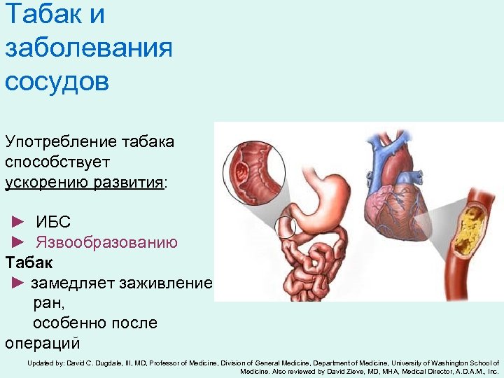 Табак и заболевания сосудов Употребление табака способствует ускорению развития: ► ИБС ► Язвообразованию Табак