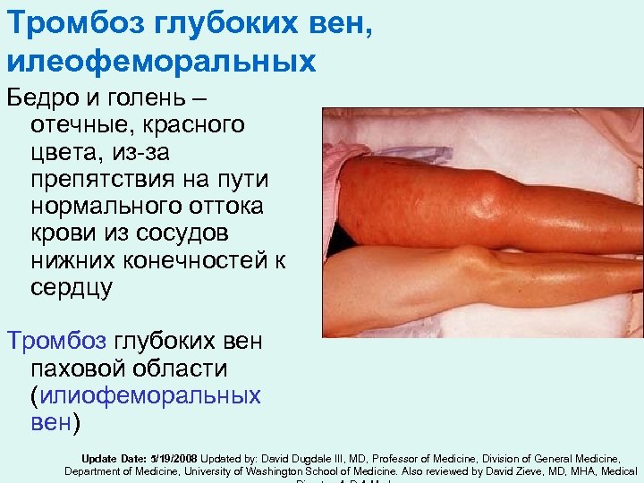 Тромбоз глубоких вен, илеофеморальных Бедро и голень – отечные, красного цвета, из-за препятствия на