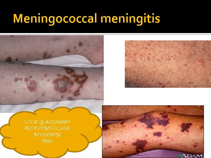 Meningococcal meningitis LOOK @ AGE/ARMY RECRUITS/COLLEGE STUDENTS/ Rash 