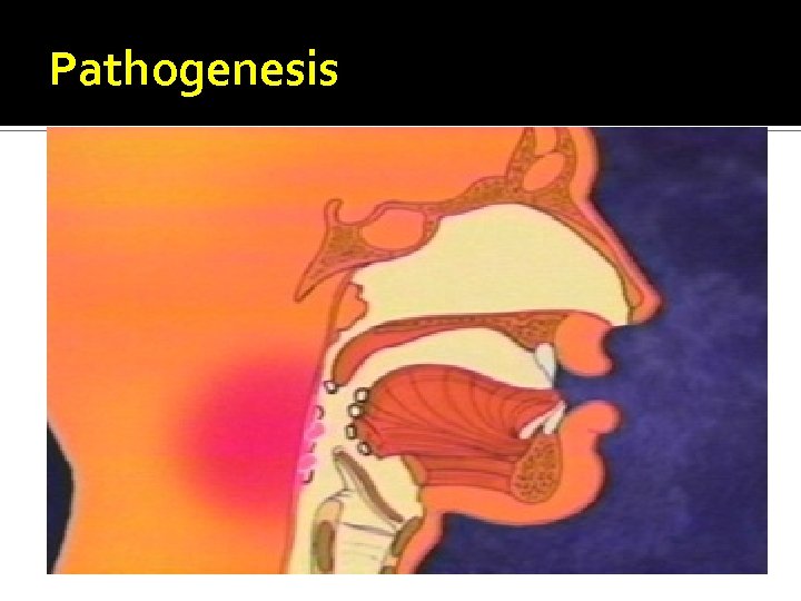 Pathogenesis 