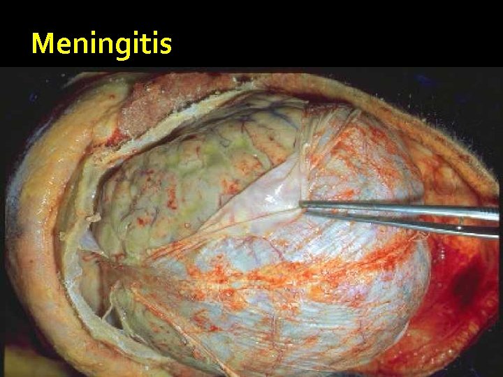 Meningitis 