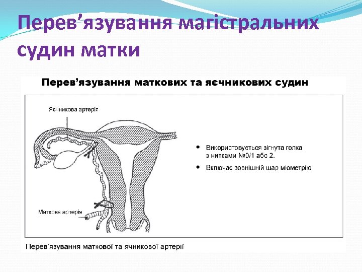 Перев’язування магістральних судин матки 