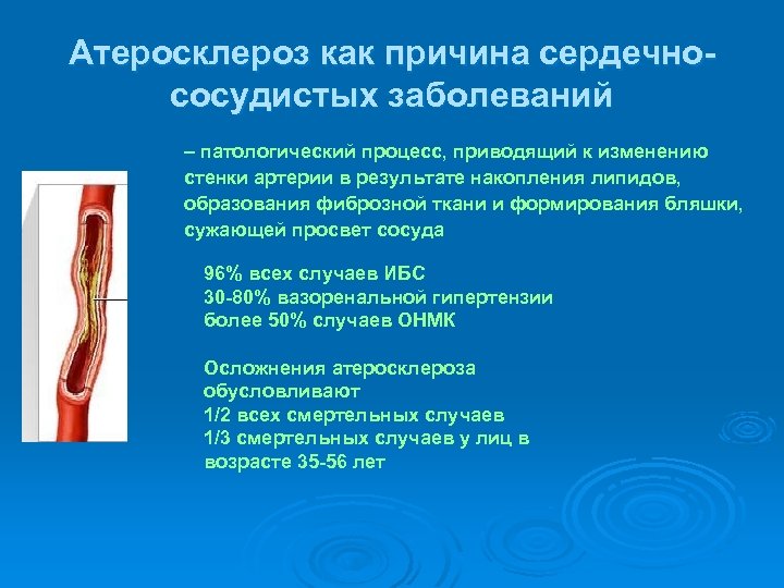 Атеросклероз как причина сердечнососудистых заболеваний – патологический процесс, приводящий к изменению стенки артерии в