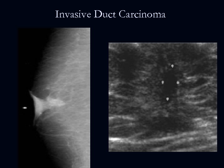 Invasive Duct Carcinoma 