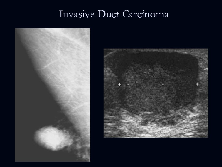 Invasive Duct Carcinoma 