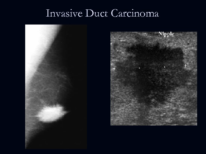 Invasive Duct Carcinoma 