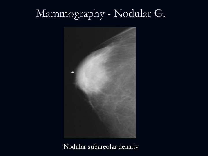 Mammography - Nodular G. Nodular subareolar density 