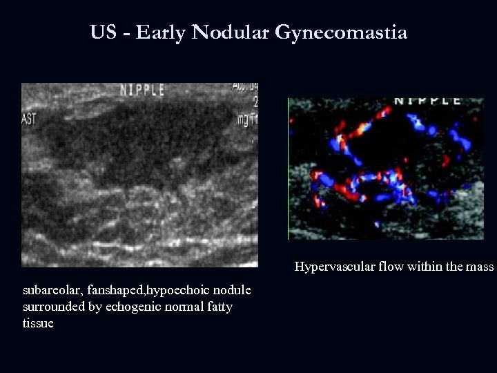 US - Early Nodular Gynecomastia Hypervascular flow within the mass subareolar, fanshaped, hypoechoic nodule