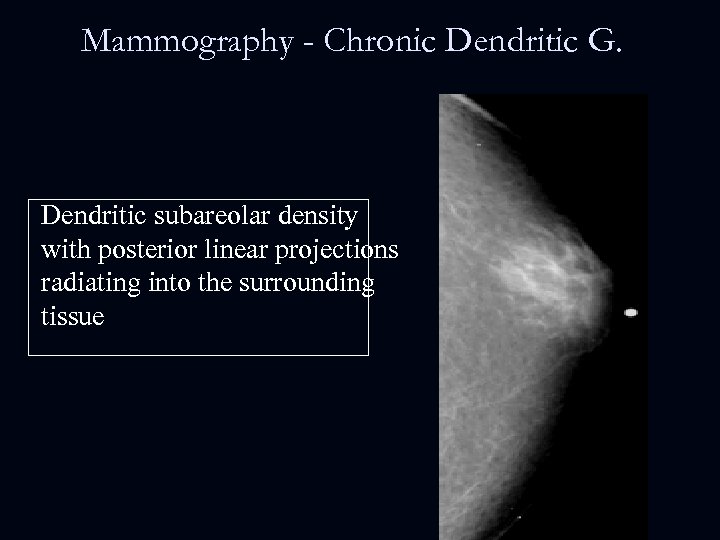 Mammography - Chronic Dendritic G. Dendritic subareolar density with posterior linear projections radiating into